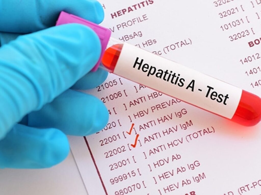 CinfaSalud Imagen Hepatitis A 60 1024x768